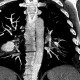 Pulmonary embolism, CT angiogram sign, pulmonary infarction: CT - Computed tomography